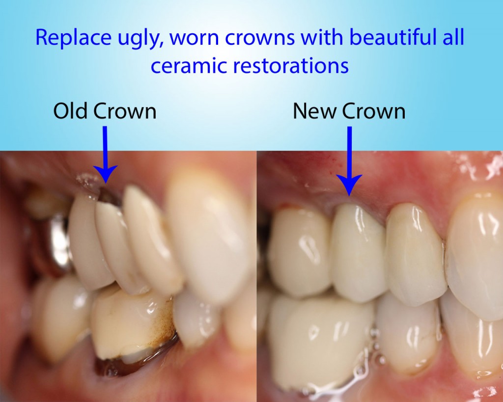 OldCrown1 East Bradford Dental